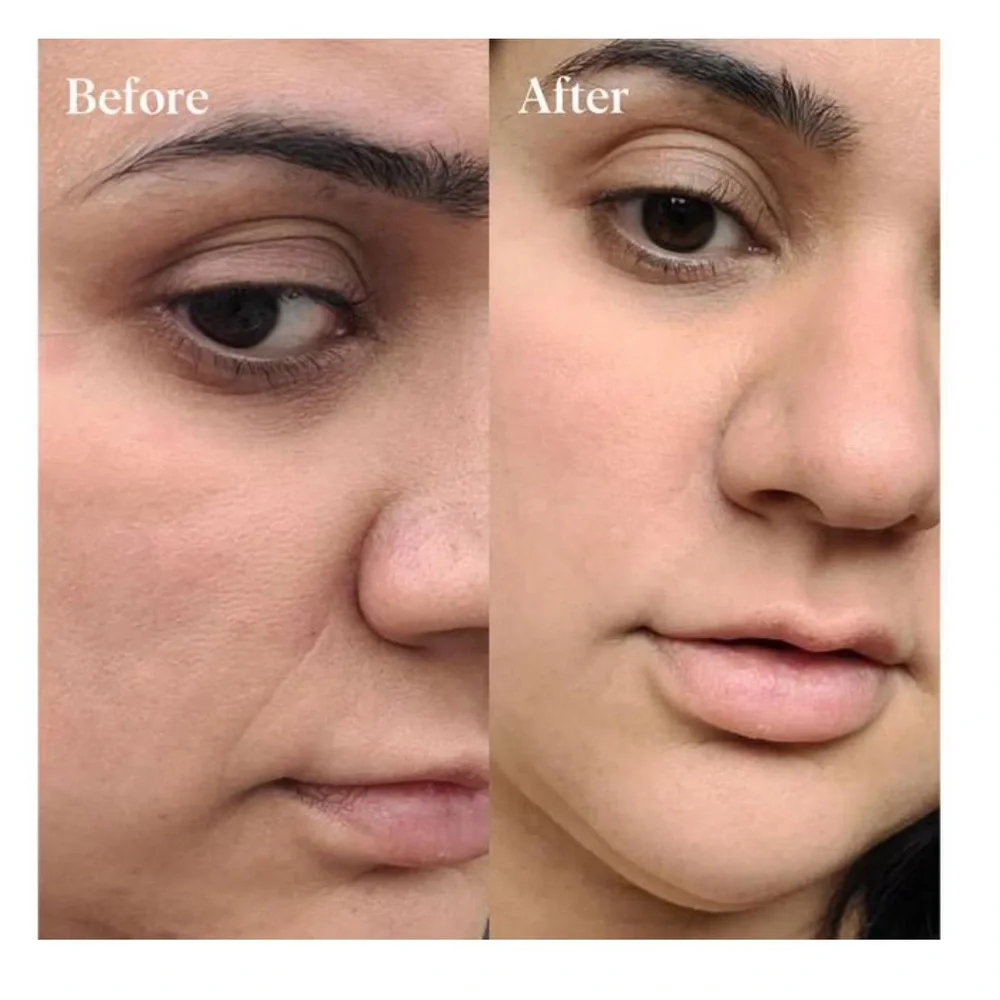 NWT Wrinkles Schminkles Self-Dissolving Microneedle Patches 8 Pack - Picture 2 of 7